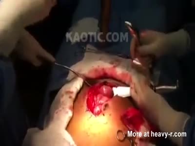 Electric Eel Surgically Removed From Man's Ass