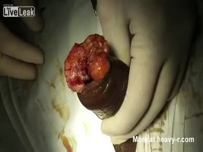 Removal of Maggots in Penis